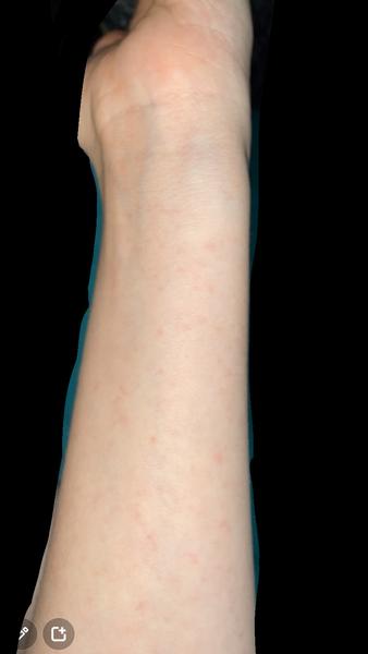 Mám vyrážky po celom tele. Je to alergia?