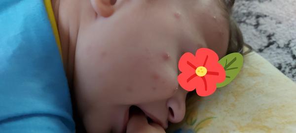 Čo spôsobil vyrážky na tvári, rukách a nohách?