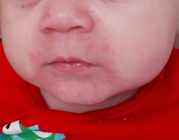 Aké vyrážky má môj 7 mesačný synček na tváričke?