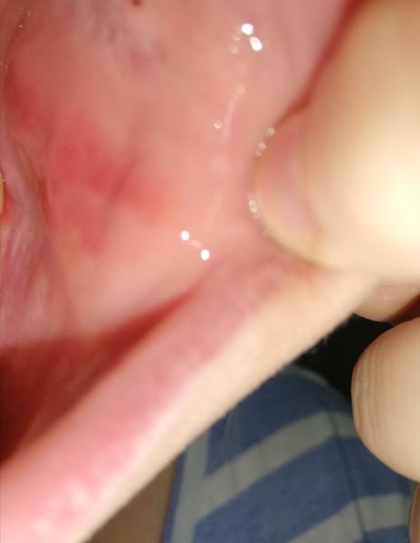 Prečo mám zapálenú ústnu dutinu?