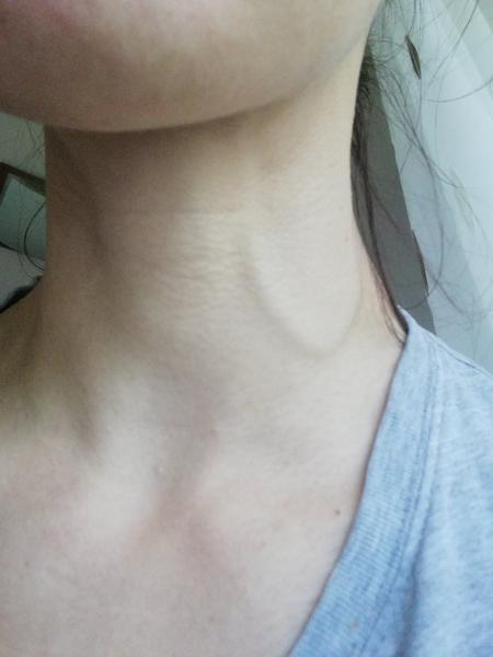 Prečo mám na ľavej strane krku zväčšenú žilu?