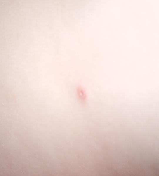 Vyrážky a pľuzgiere na tele