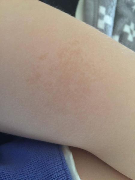 Hnedý fľak u štvorročnej dcérky