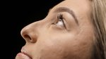 Rhinoplastika po úraze nosa: Ísť alebo neísť?