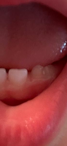 Problém so zubom u 16-mesačného dieťaťa