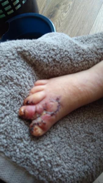 Ako dlho trvá hojenie po operácii prstov?