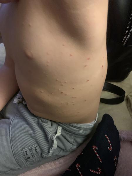 Riešenie molusiek u dvojročného dieťaťa: praktické rady a skúsenosti