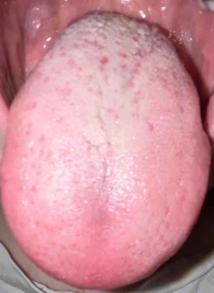 Je biely povlak na jazyku normálny?