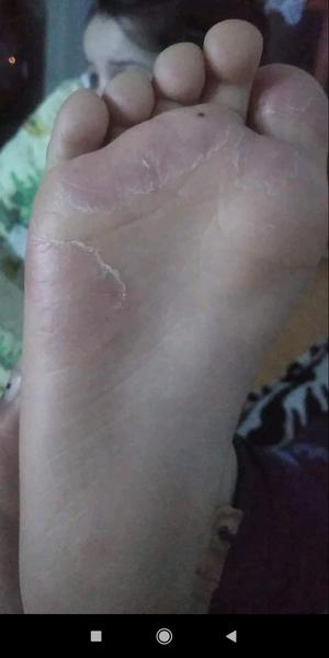 Môj 7-ročný syn má problém s kožou na chodidlách