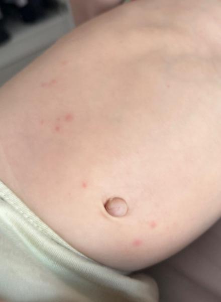 Štipance alebo vyrážky u detí