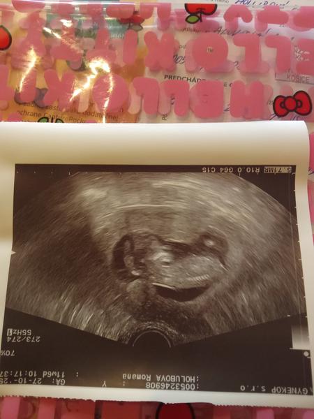 Čakáme podľa ultrazvuku chlapca alebo dievča?