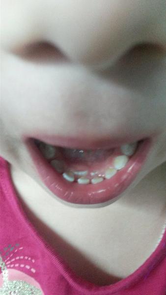 Nové zúbky vytláčajú mliečne jednotky