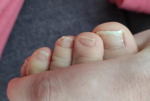 Z čoho môže mať môj 2,5-ročný syn lámavé nechty na nohách?