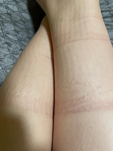 Ako sa zbaviť príšerných otlakov na nohách?