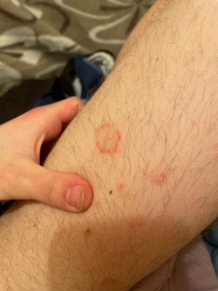 Okrúhle fľaky na nohách