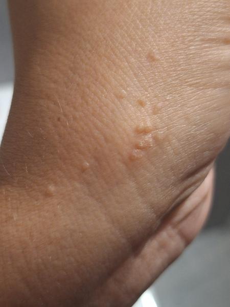 Ako odstrániť ploché bradavice na ruke a nad perou?