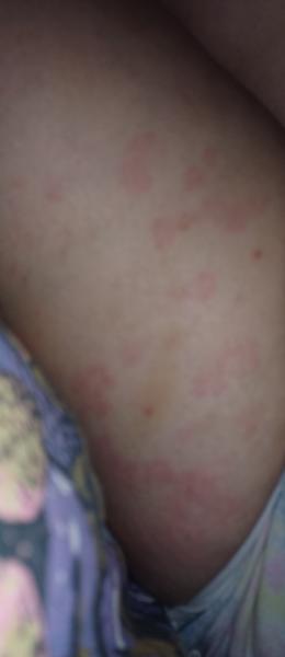 Má môj syn pityriasis rosea? Skúsenosti ostatných vítané