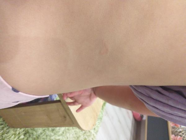 Fľaky u štvorročnej dcéry