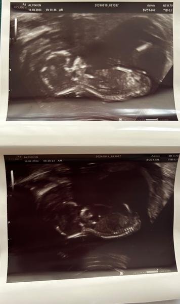 Pohlavie dieťaťa: Určovanie pomocou ultrazvuku?