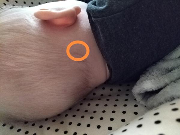 Čo znamenajú vypuklé miesta na zátylku u 7 mesačnej dcérky?