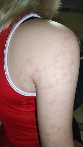 Čo môžu znamenať červené fľaky na pokožke?