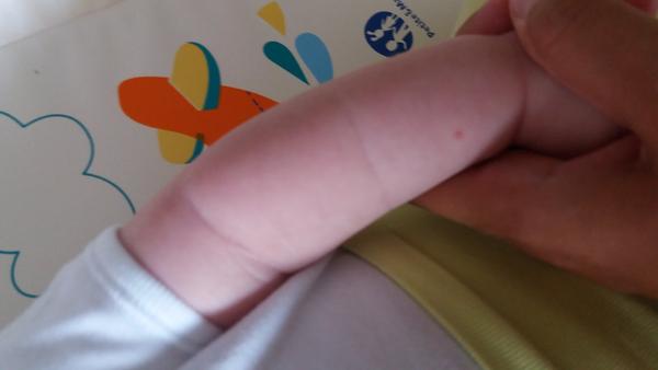 Vyrážky na bábätkových ručičkách