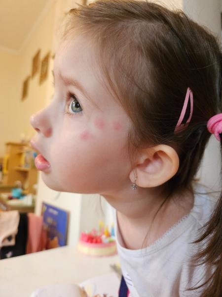 Sú to štípance od komára?