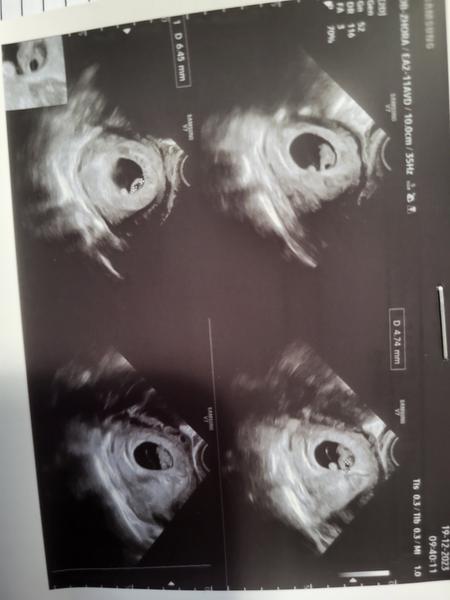 Sono v 8. týždni: Riziko tekutiny v hlavičke bábätka?