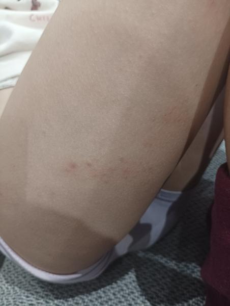 Svrbiace vyrážky na nohách