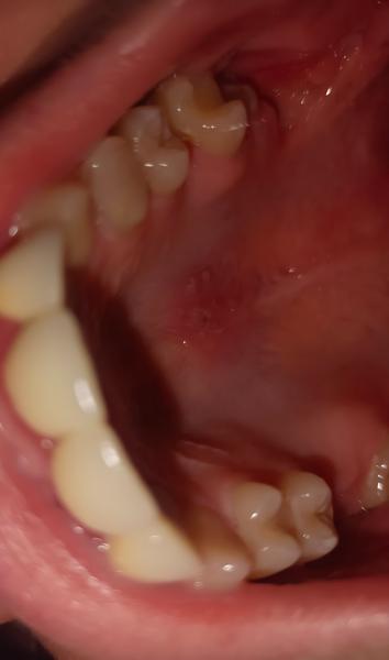 Čo spôsobuje bolesť na hornom podnebí?