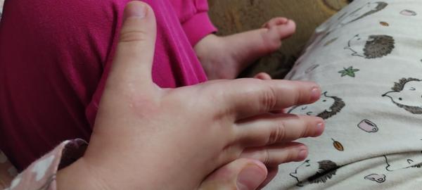 Suché červené fľaky u trojročnej dcérky