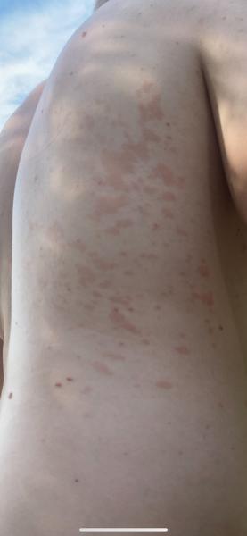 Fľaky na koži - z čoho mohli vzniknúť?