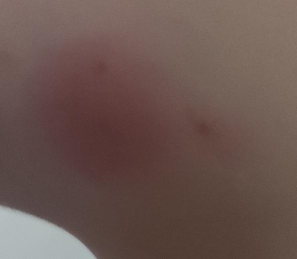 Štípance od komárov: Ako predísť komplikáciám?