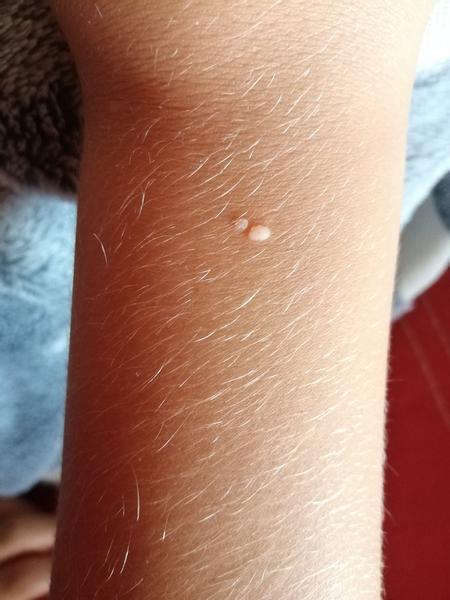 Čo môže spôsobiť kožnú vyrážku?