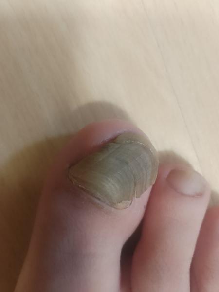 Chorý nechet na nohe: Ako riešiť problémy a bolesť?