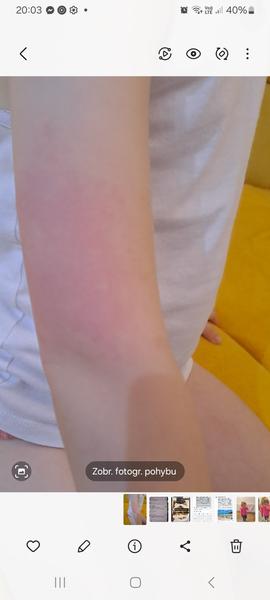 Čo spôsobuje svrbivé fľaky na rukách dieťaťa?