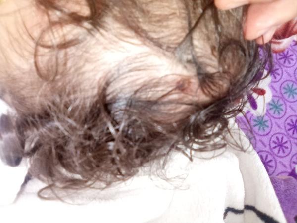 Ako riešiť vyrážky na hlave u detí?