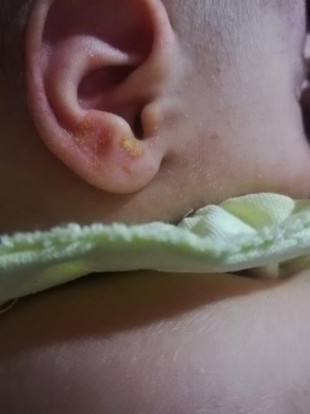 Fliačik na ušku, čo to môže byť?