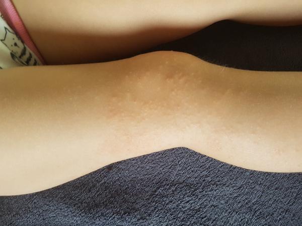 Poznáte takýto ekzém?