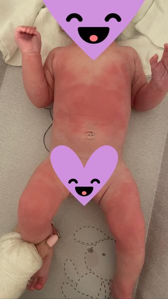 Čo nám naozaj zaberie na červené fľaky na tele?